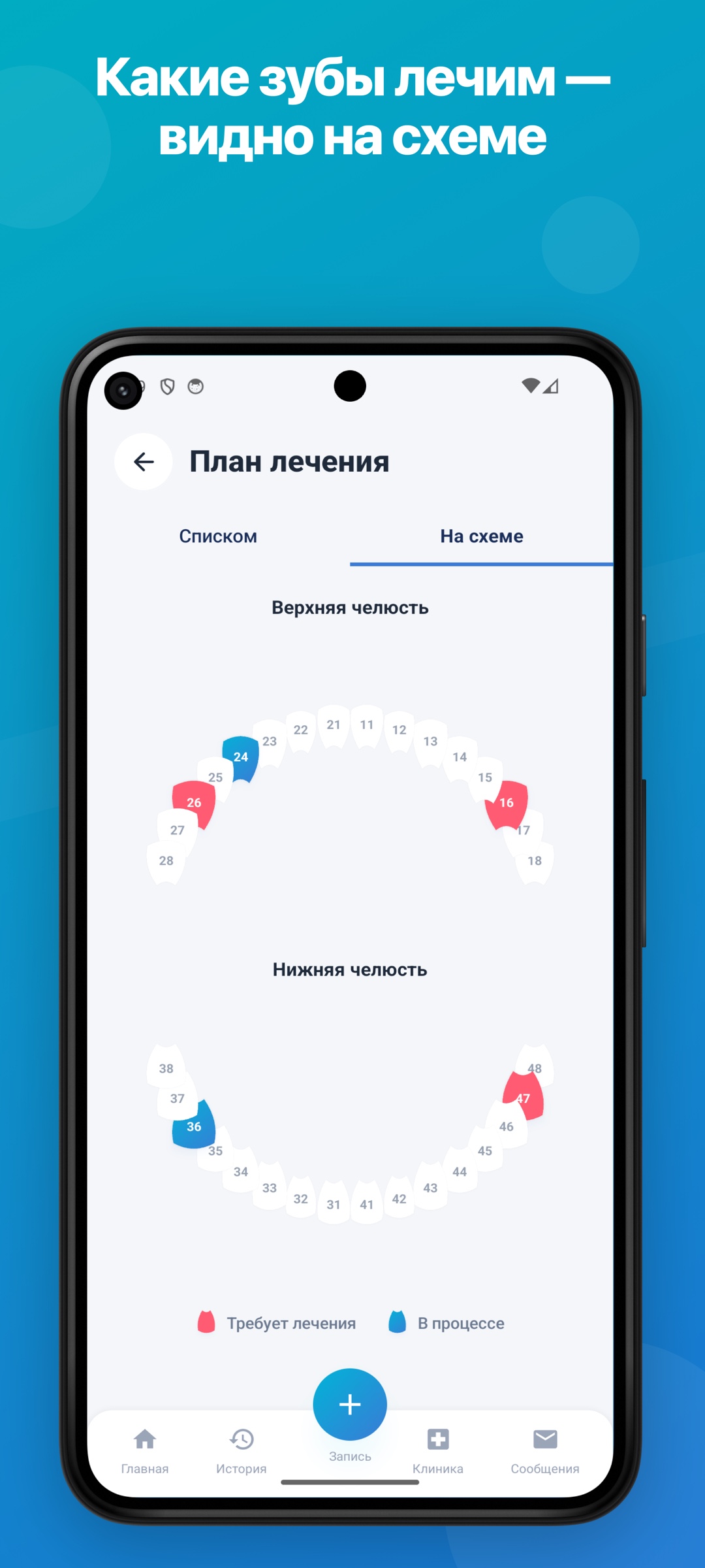 План лечения — схема зубов